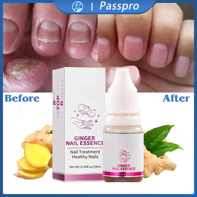 Obat Kuku Ampuh Jamur Kuku Kaki Perawatan Kuku Tangan Dan Kaki Cream Kuku Jamur Dan Rusak