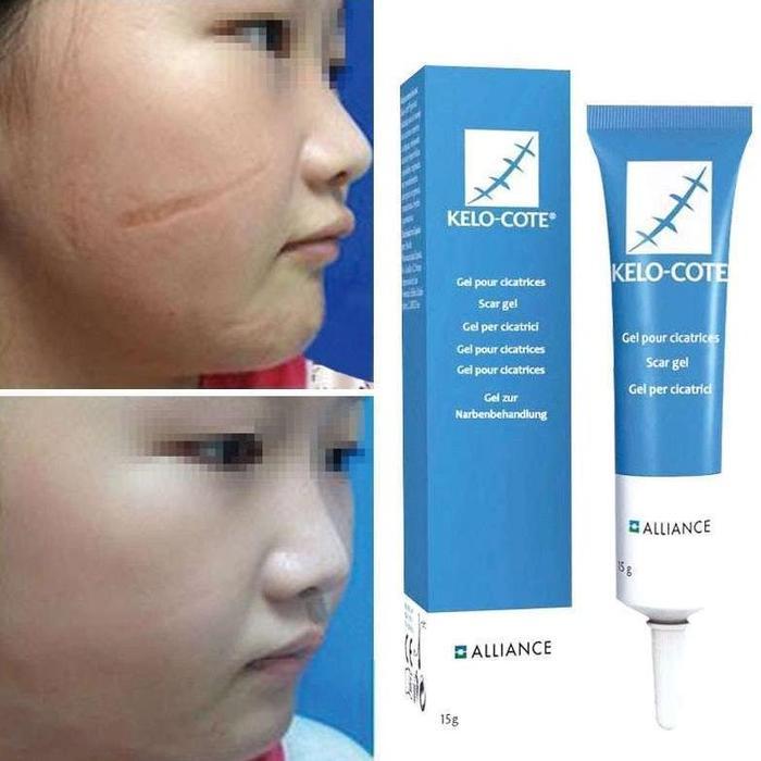 Produk Original Kelo Cote Gel Obat Bekas Luka Operasi Keloid [15 G]