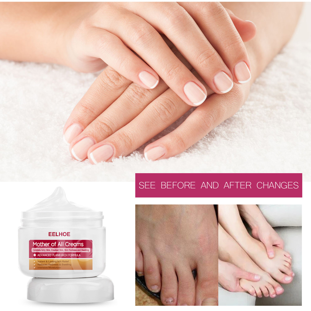 EELHOE Pelembab Kulit Kering Dan Gatal 30g Psoriasis Cream Salep Gatel Obat Eksim Krim Gatal Kulit K