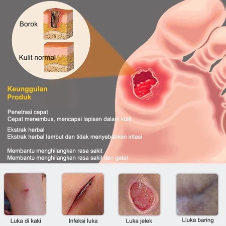 Krim Luka baring/Penyembuhan luka/Luka diabetes/ Krim dekubitus/Mengobati dekubitus 20g