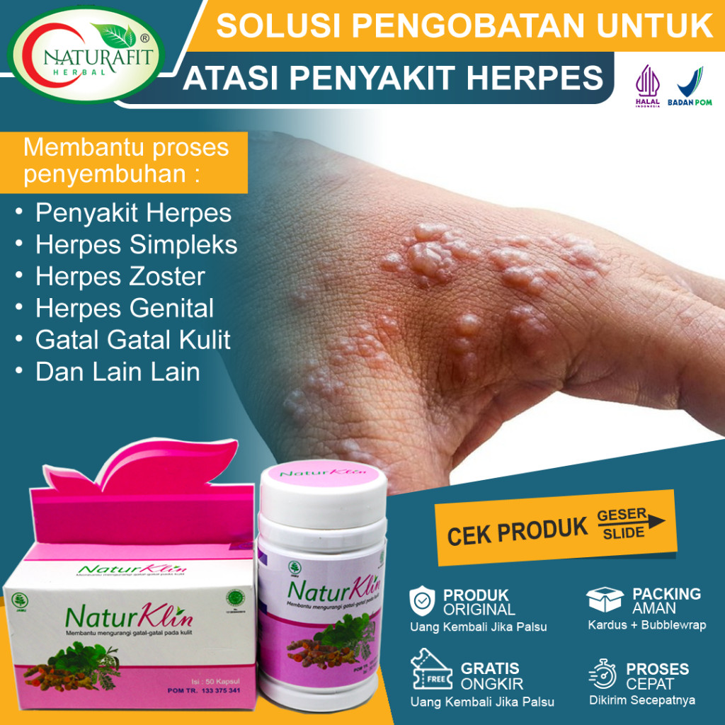 Obat Herpes Paling Ampuh Gatal Gatal Herpes Kulit Zoster Genital Herpes Di Bibir Herpes Kelamin Bint