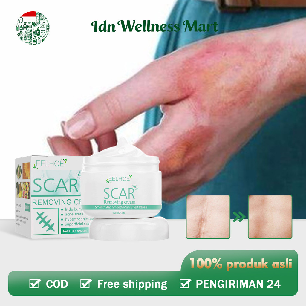 EELHOE salep bekas luka Ampuh dermatik salep penghilang bekas luka ori/obat penghilang bekas luka ko