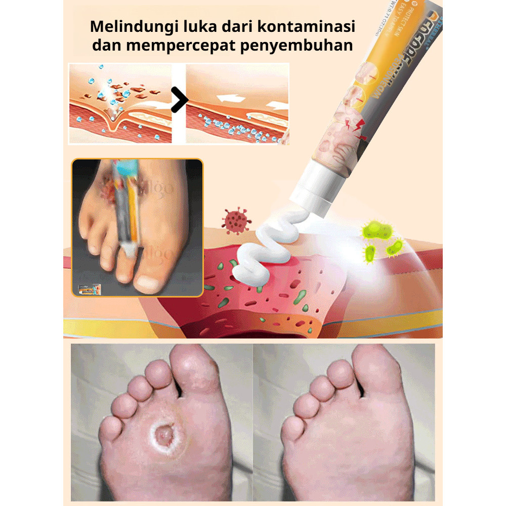 Sembuhkan Luka Diabetes Cepat  Krim Perawatan Luka Diabetes SL Krim Luka Diabetes/Perawatan Luka/Oba