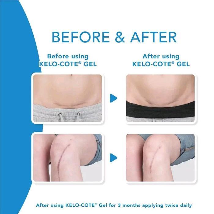 Kelo Cote gel original penghilang bekas luka