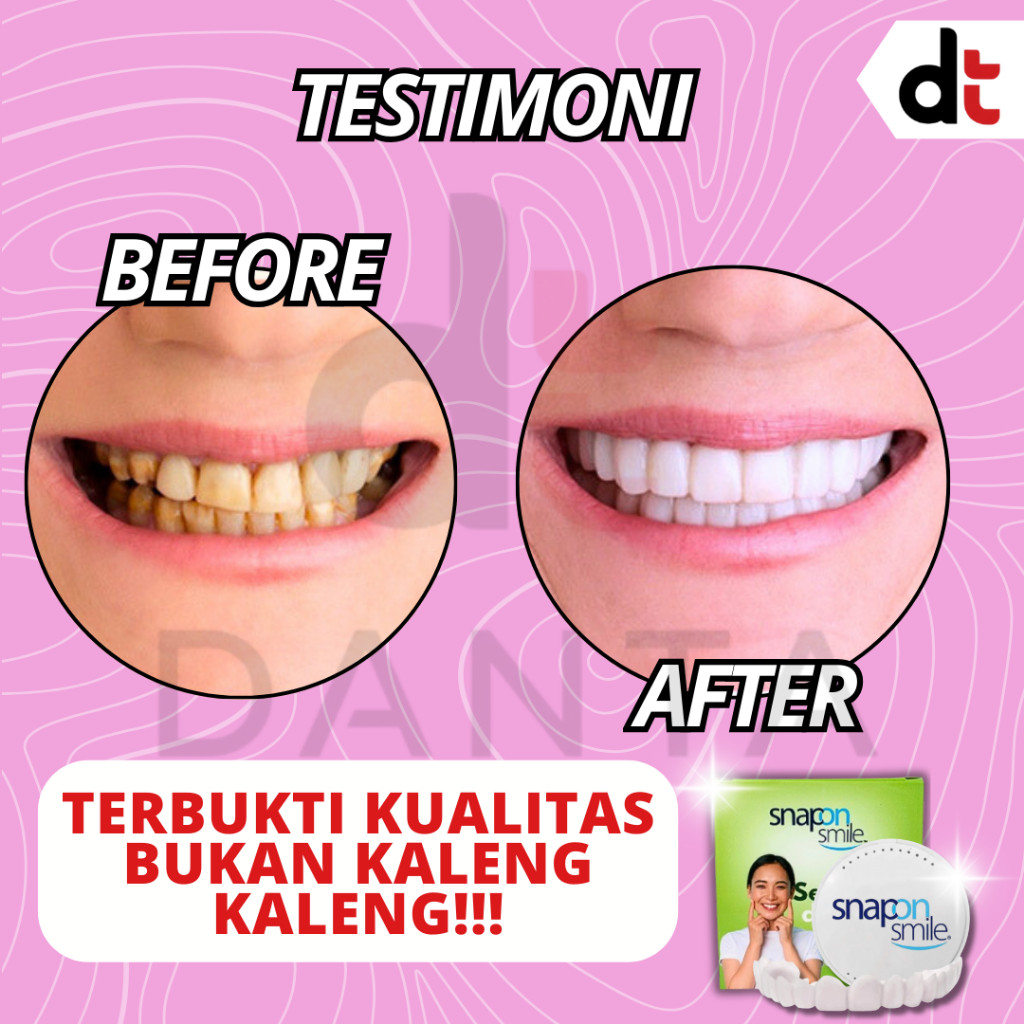 ReadySnap On Smile Gigi Palsu Veneer Gigi Perapi Pemutih  Renggang Berantakan Tonggos Ompong Tanpa B