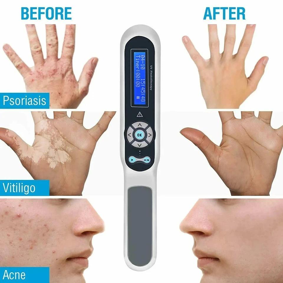 Instrumen Fototerapi Ultraviolet Narrowband UVB 311nm, Alat Perawatan Psoriasis, Lampu Perawatan Pen
