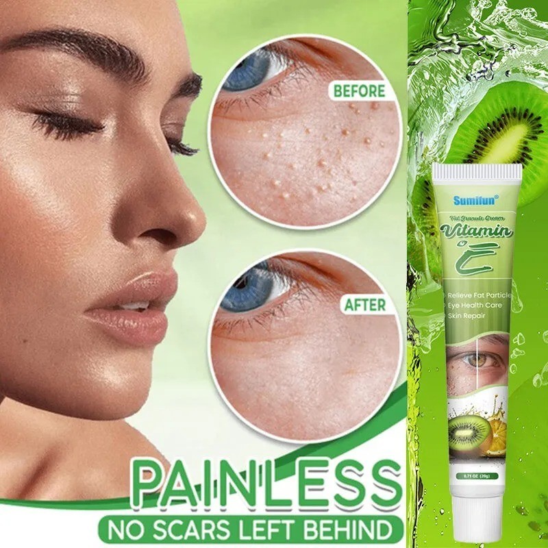 (ORIGINAL) VE Fat Particles Eye Cream 20g – Krim Penghilang Milia, Syringoma & Lemak di Bawah Mata, 