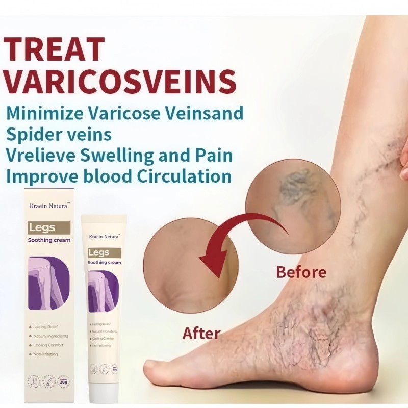 Varises Hilang Cepat-Kreain Nature Gel Varises Obat Varises Paling Ampuh Menghilangkan varises Varic