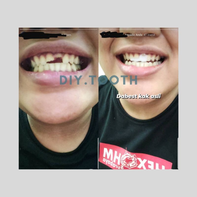 ReadyDIY TOOTH set lengkap / gigi palsu sementara / gigi palsu bisa dibentuk sendiri / veener / temp