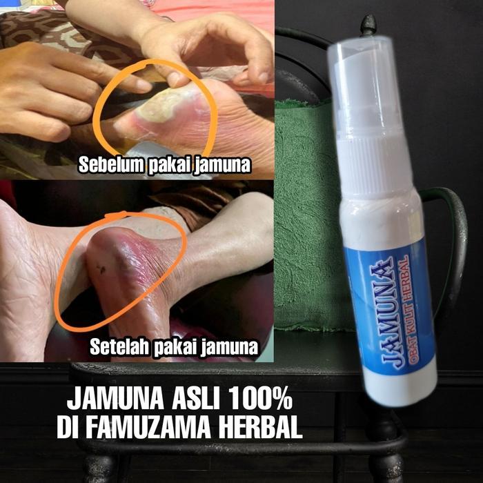 [SOLUSI] OBAT KULIT GATAL EKSIM/LUKA BAKAR/DIABET PALING MANJUR