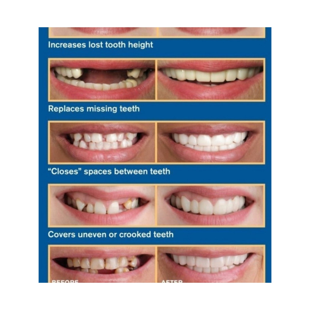 FLAS SALE Snap On Smile Veneer Instan Gigi Palsu Tiruan Kesehatan Mulut Mouth Ok