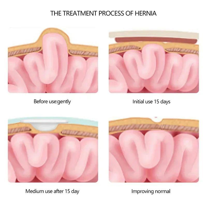 2pcs Umbilical Hernia Therapy Treatment Belt Breathable Bag Elastic Cotton Strap for 0-1 Years Old B