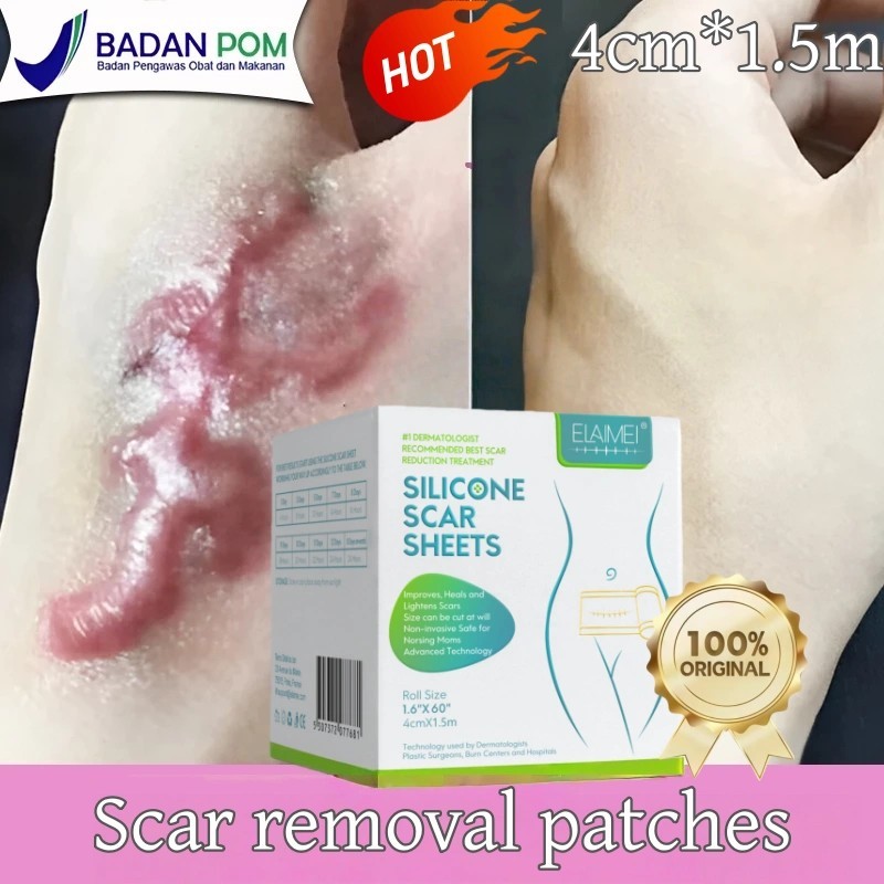 ELAIMEI Silicone Keloid 4cm*1.5m Silicone Keloid Plester Scar Tape Keloid Bekas Luka Silicon Scar Sh