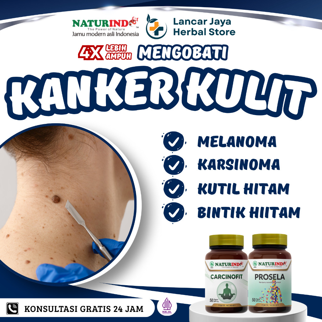 Obat Kanker Kulit Karsinoma Melanoma Kutil Hitam Herbal Carcinofit