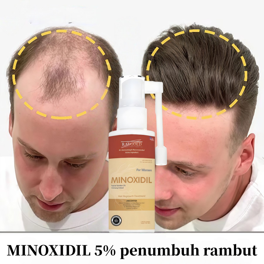 MINOXIDIL 5% for MEN penumbuh rambut with Ginseng Vera made in USA - RAYGOLD - MINOX MINOKSIDIL MINO