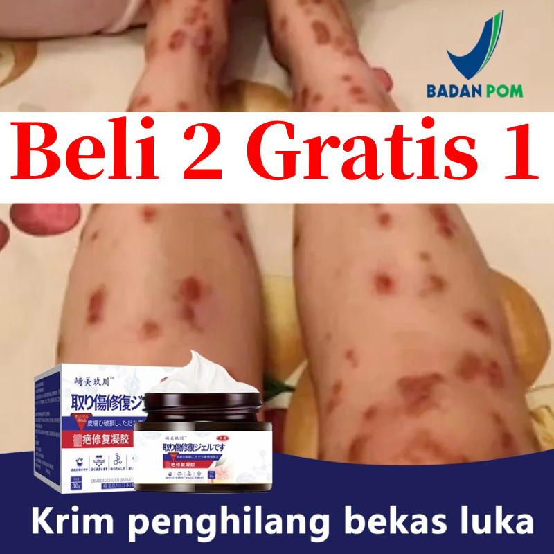 Menghilangkan Bekas Luka Gigitan Serangga Bekas Luka Bakar Luka Bakar Stretch Mark Bekas Jahitan kri