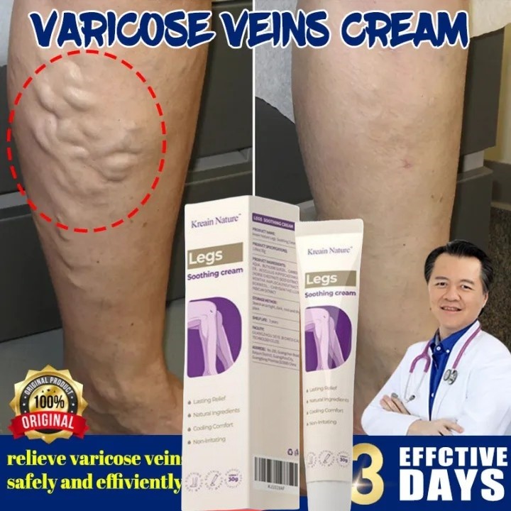 Kreain Nature Varises obat parises kaki paling ampuh salep varises 30g salep laba-laba Pengobatan Va