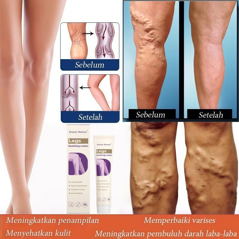 Varicose Veins Cream Leg soothing cream Krim Penghilang Varises Di Kaki Varicose Veins Cream Obat Va