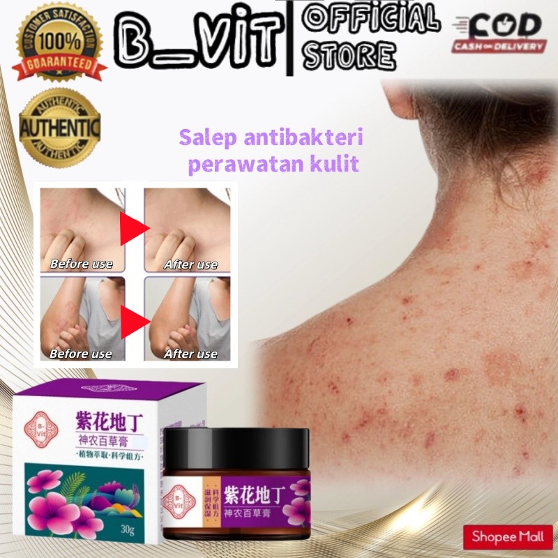 B-Vit Salep gatal paling ampuh 30g Salep gatal selangkangan Salep gatal pada miss v Anti jamur Mengh
