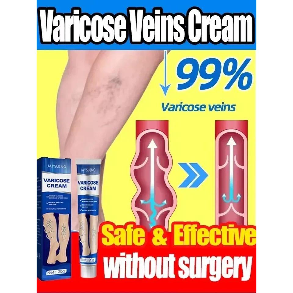 Ointment for Varicose Veins Eliminate Vasculitis Phlebitis to Relieve Spider Leg Pain Treatment Herb
