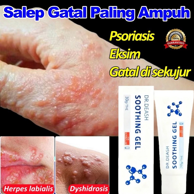 Salep Eksim Kering Dan Gatal Salep Gatal Paling Ampuh Obat Gatal Selangkangan Psoriasis Cream Salep 