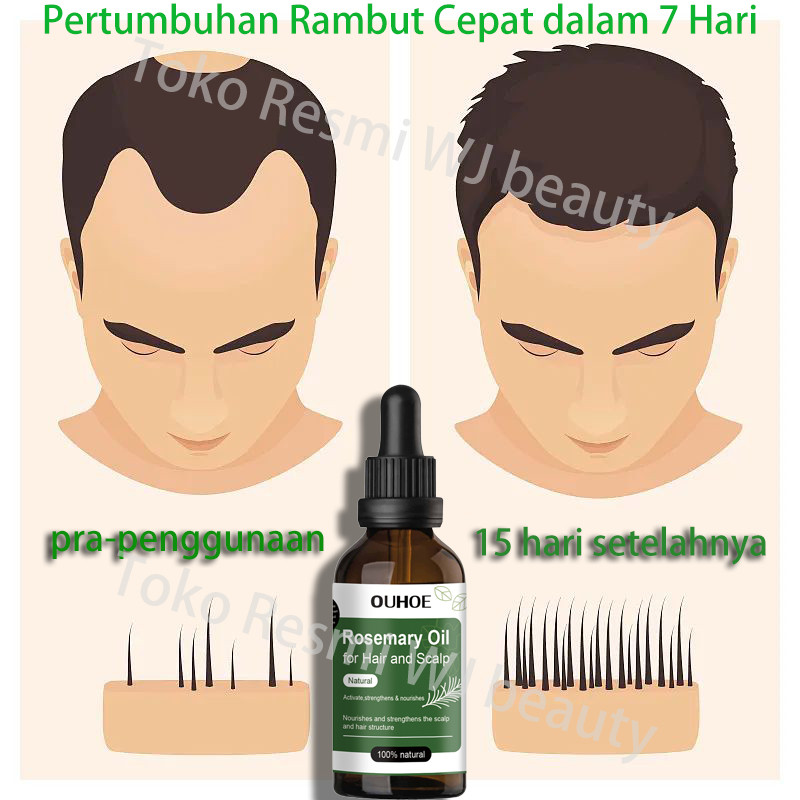 Serum Penumbuh Rambut Botak Rosemary Oil Rambut Obat Penumbuh Rambut Hair Growth Serum Minyak Penumb