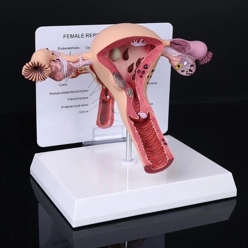 Biology Teaching, Anatomy Lesion Uterus Model, Human Female Uterus Ovary sease ssection Pathology Mo