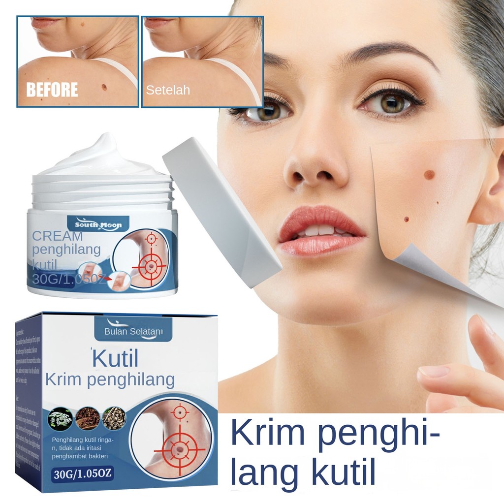 South Moon Krim Perawatan Kutil Kulit Tahi Lalat Hitam di Kepala dan Leher, Butiran Daging, Krim Pen