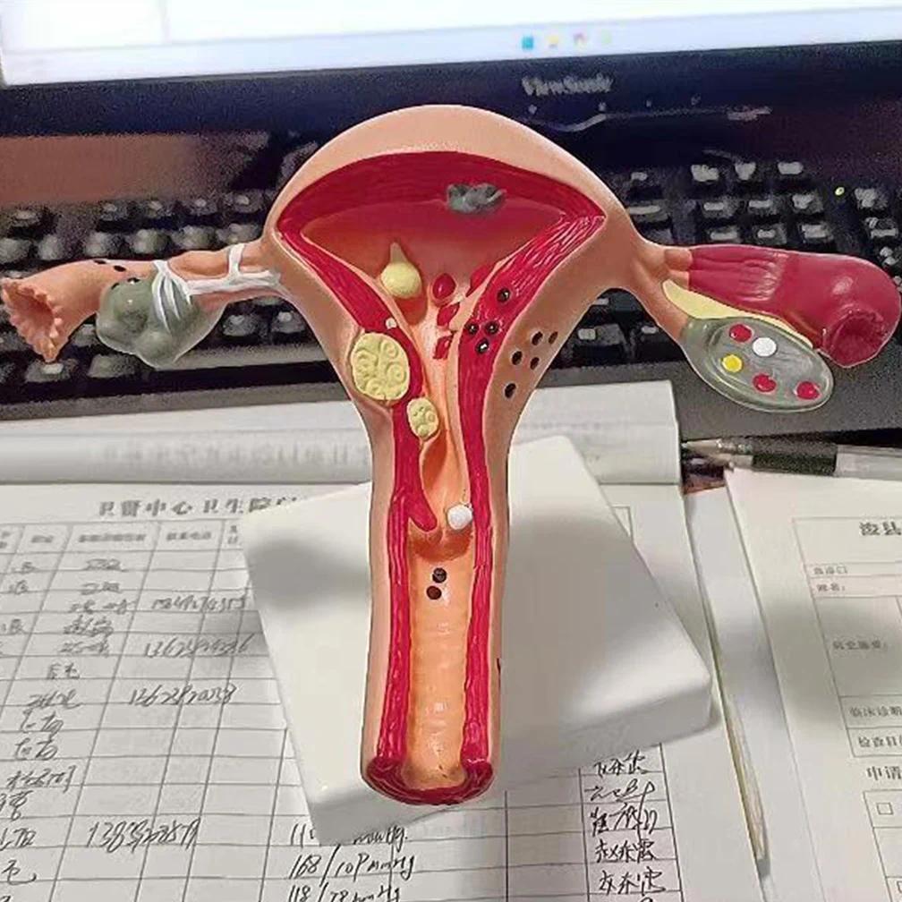 Cross Section Structure Model Human Pathological Uterus Ovary Model Uterus Anatomical Anatomy Female