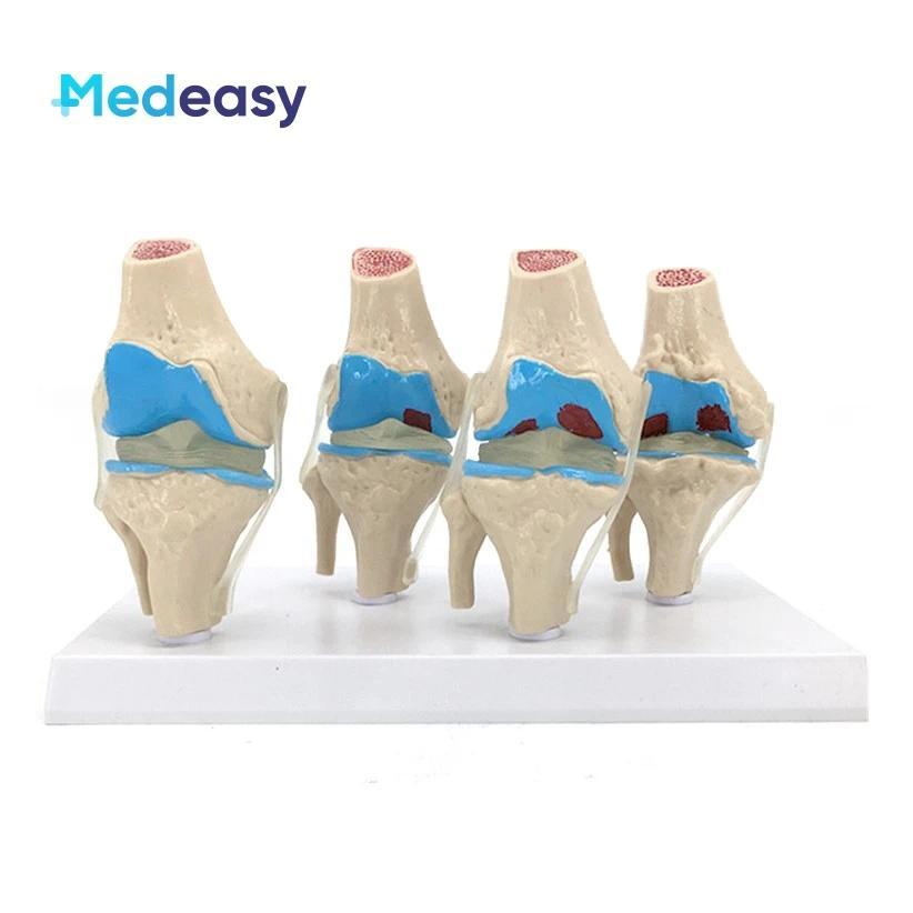 Human 4 Stage Osteoarthritis Knee Joint Model, Pathological Knee Model