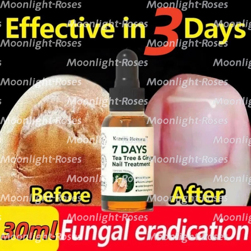 Serum Kuku Tea Tree Ginger 30ml Serum kuku jamur dan rusak obat kuku rusak paling ampuh obat penumbu