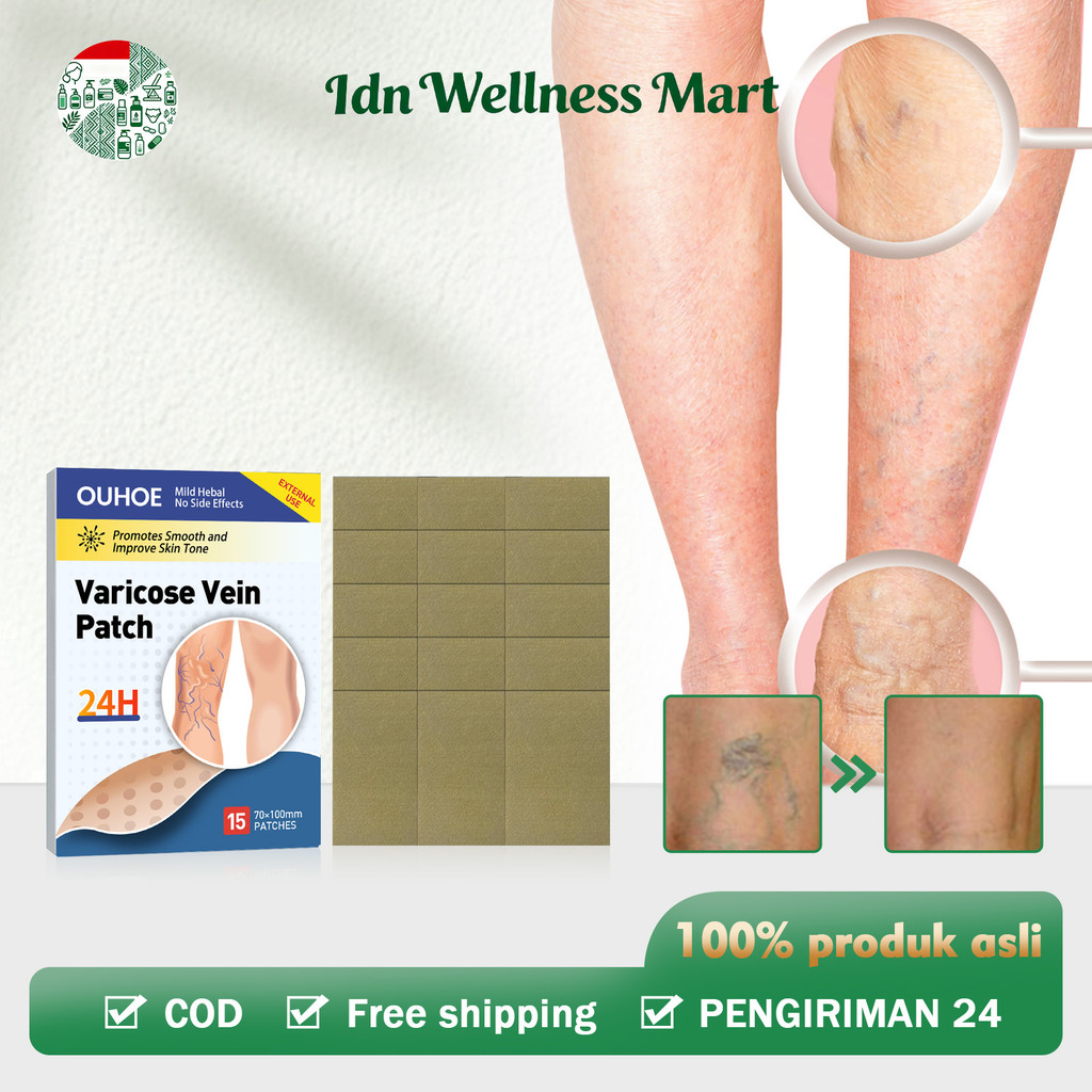 OUHOE 15pcs Koyo Varises Penghilang Varises Di Kaki Varicose Patch Obat Varises Herbal Koyo Varicose