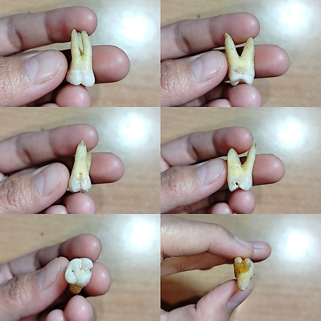 Gigi Molar 16