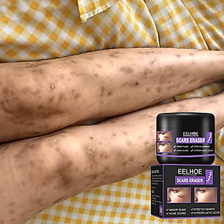 penghilang bekas luka hitam koreng salep penghilang bekas luka hitam penghilang bekas cacar obat pen