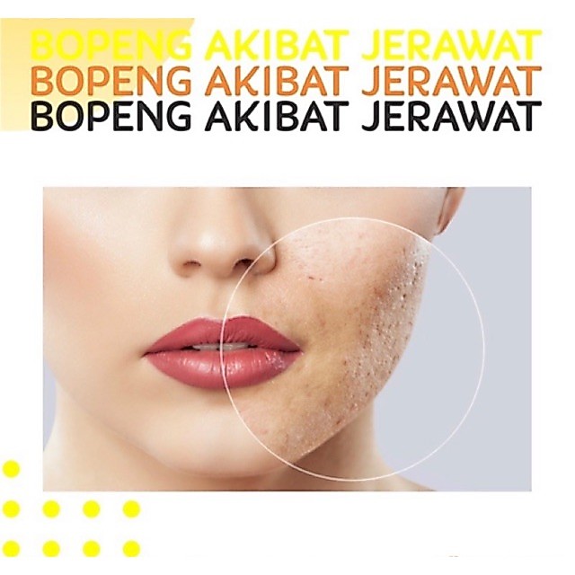 Satuan Acne Venusglow Clinic Satuan Venus glow