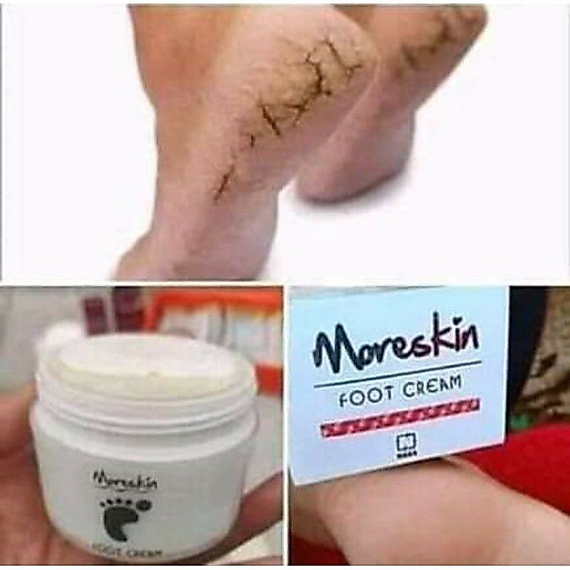 Obat Kaki Pecah Pecah Dan Kering Dan Kasar - Obat Kaki Rayapan Dan Bau - Obat Kaki Pecah Dan Kering