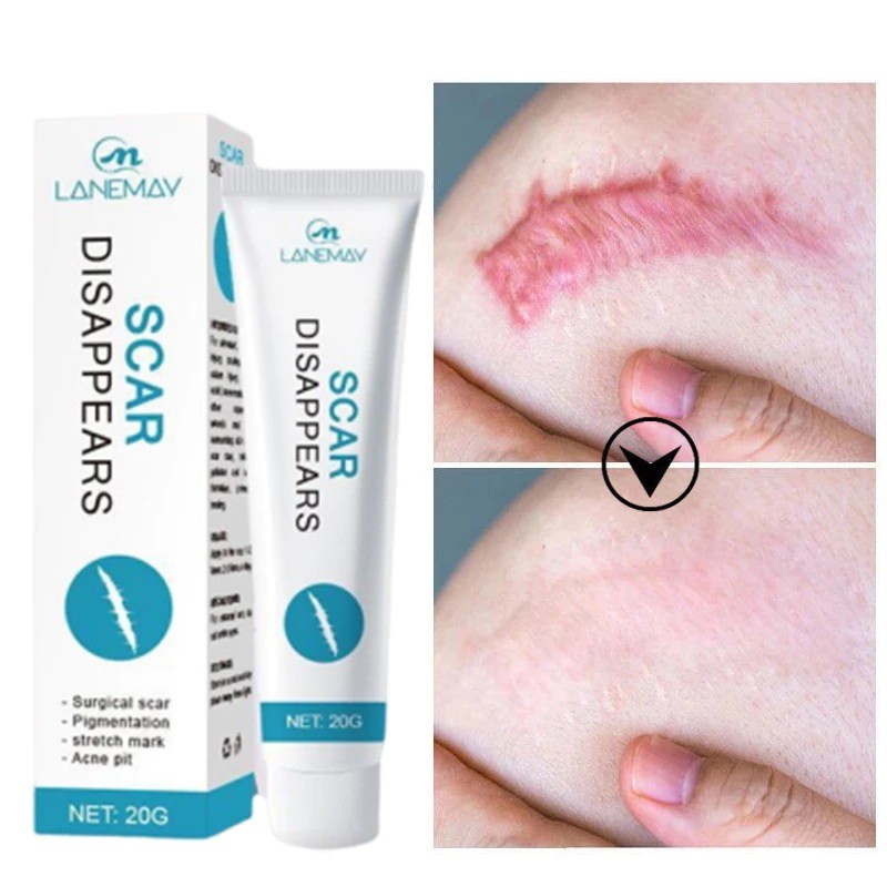 [COD]Obat penghilang bekas luka Salep penghilang bekas luka Penghilang bekas luka hitam 20g Salep ke