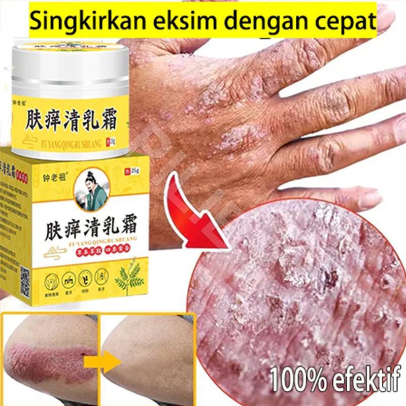salep china gatal paling ampuh Salep Eksim Kering dan Gatal Salep Bayi Untuk Kulit Iritasi obat eksi