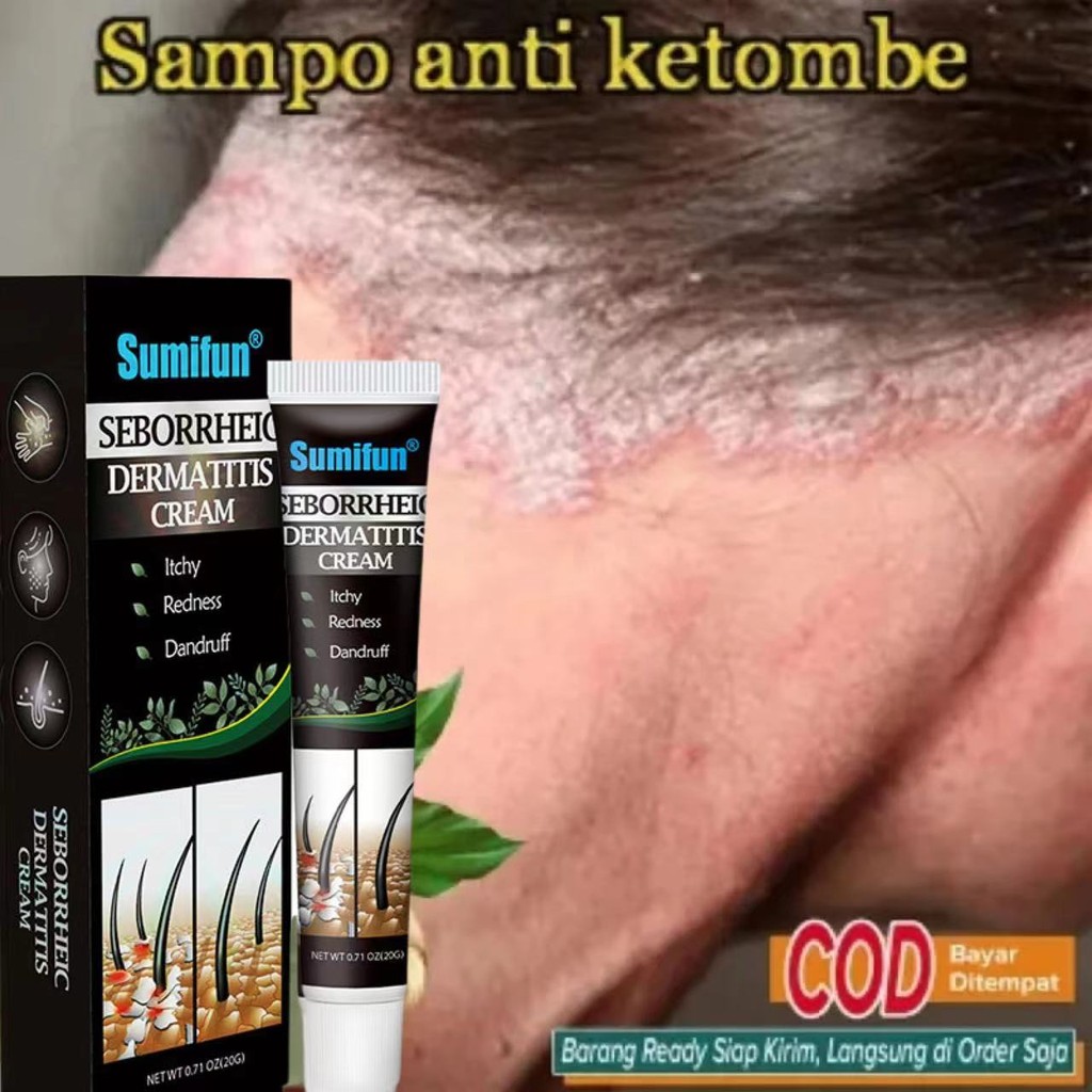 Sumifun Psoriasis Behandeling Dermatitis Eczematoid anti ketombe Penghilang Ketombe Berkerak Dan Gat