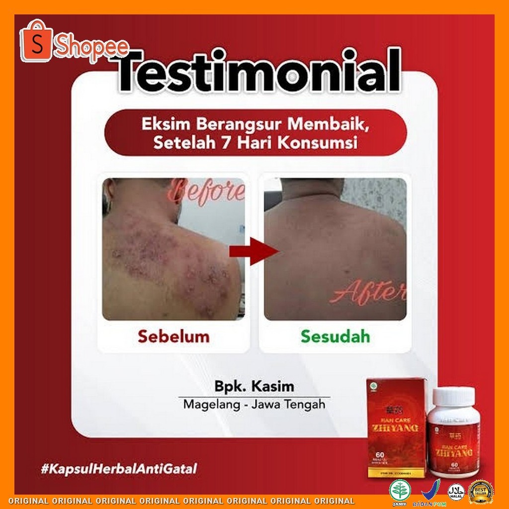 Zhiyang - Obat Herbal Untuk Membantu Meredakan Gatal Pada Kulit Alergi Biduran Kurap