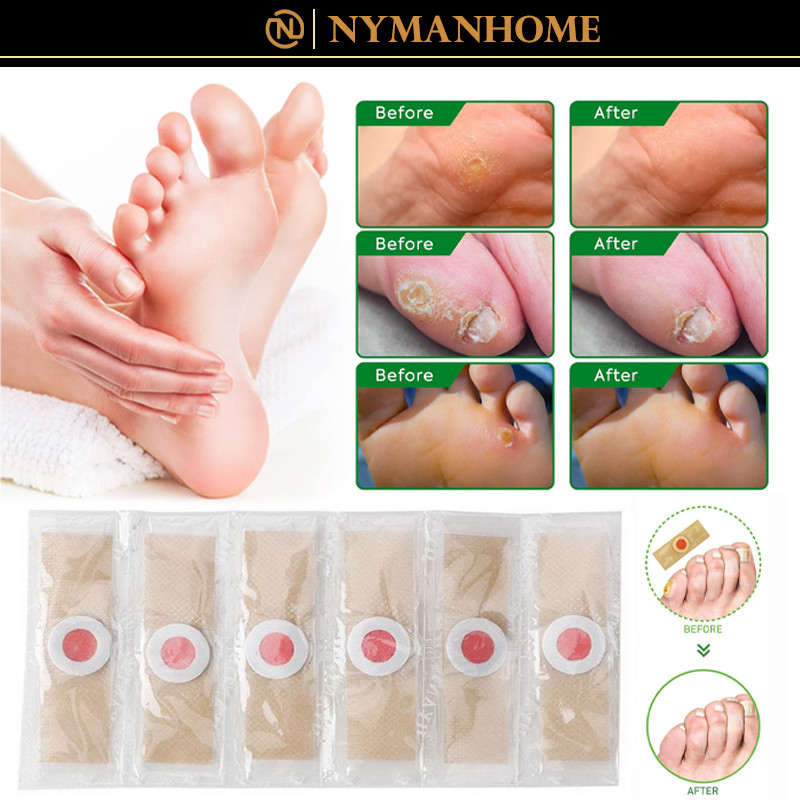 【18PCS】 Plester Obat Kutil & Mata Ikan / Plester Kutil Mata Ikan Penghilang Kutil