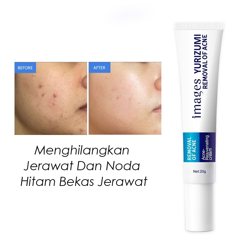 Images Yurizumi Acne Removal Cream Mengobati Jerawat Memudarkan Bekas Jerawat