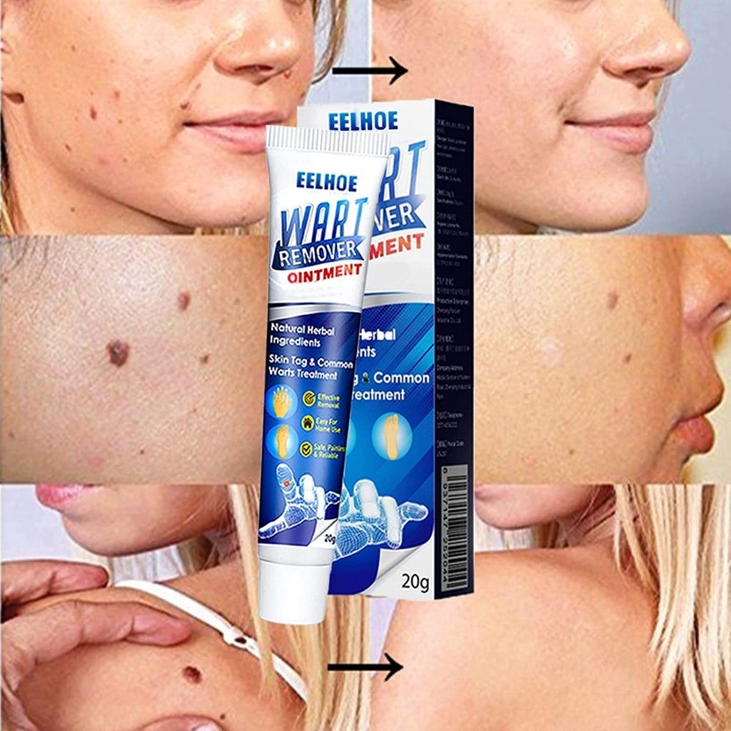 Eelhoe Wart Remover Ointment Cream Penghilang Tahi Lalat & Kutil / Obat Kutil / Obat Menghilangkan T