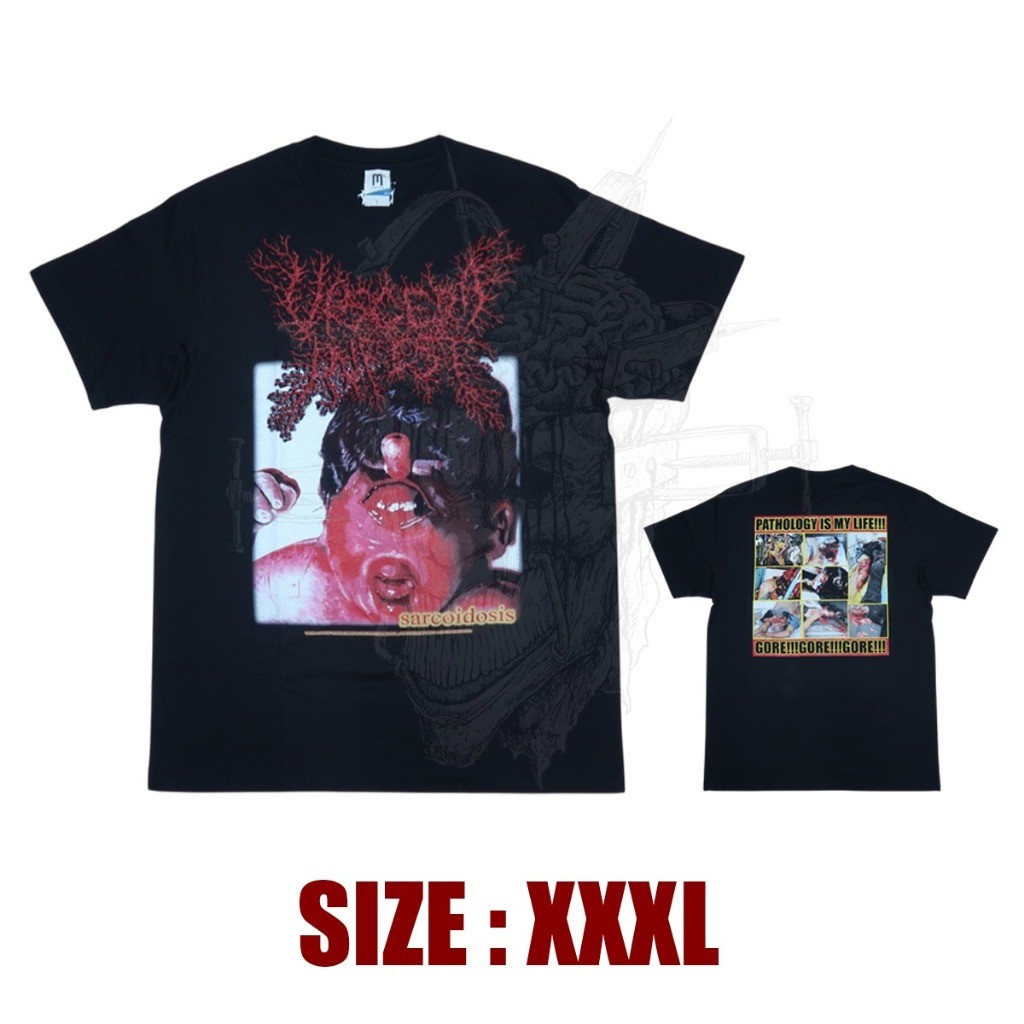 TS - VISCERA INFEST - Sarcoidosis