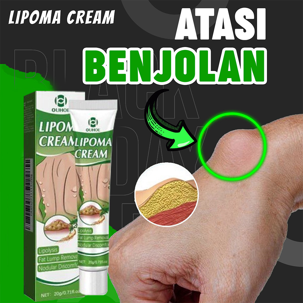 OUHOE Lipoma Cream Obat Benjolan Subkutan Lipoma Removal Cream Obat Salep Benjolan Lipoma Ampuh Herb