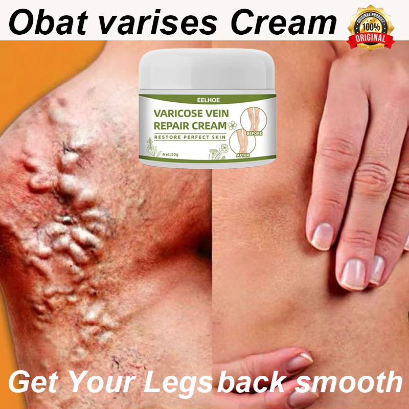 SORAYU Obat varises Cream varises paling ampuh original Varises kaki Treatment Varicose veins cream 
