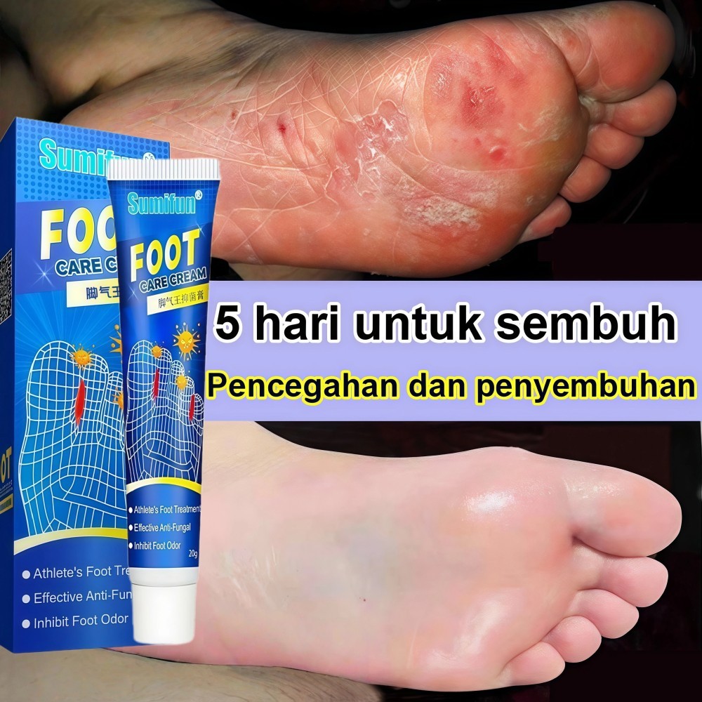 krim perawatan anti bakteri , menghilangkan jamur tinea pedis , salep perawatan kaki, krim perawatan