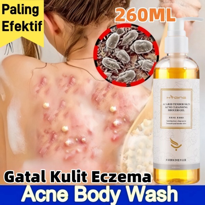 SORAYU Eczema body wash 260ml Original Pengobatan Eksim psoriasis eksim kering Kurap gatal kulit jam