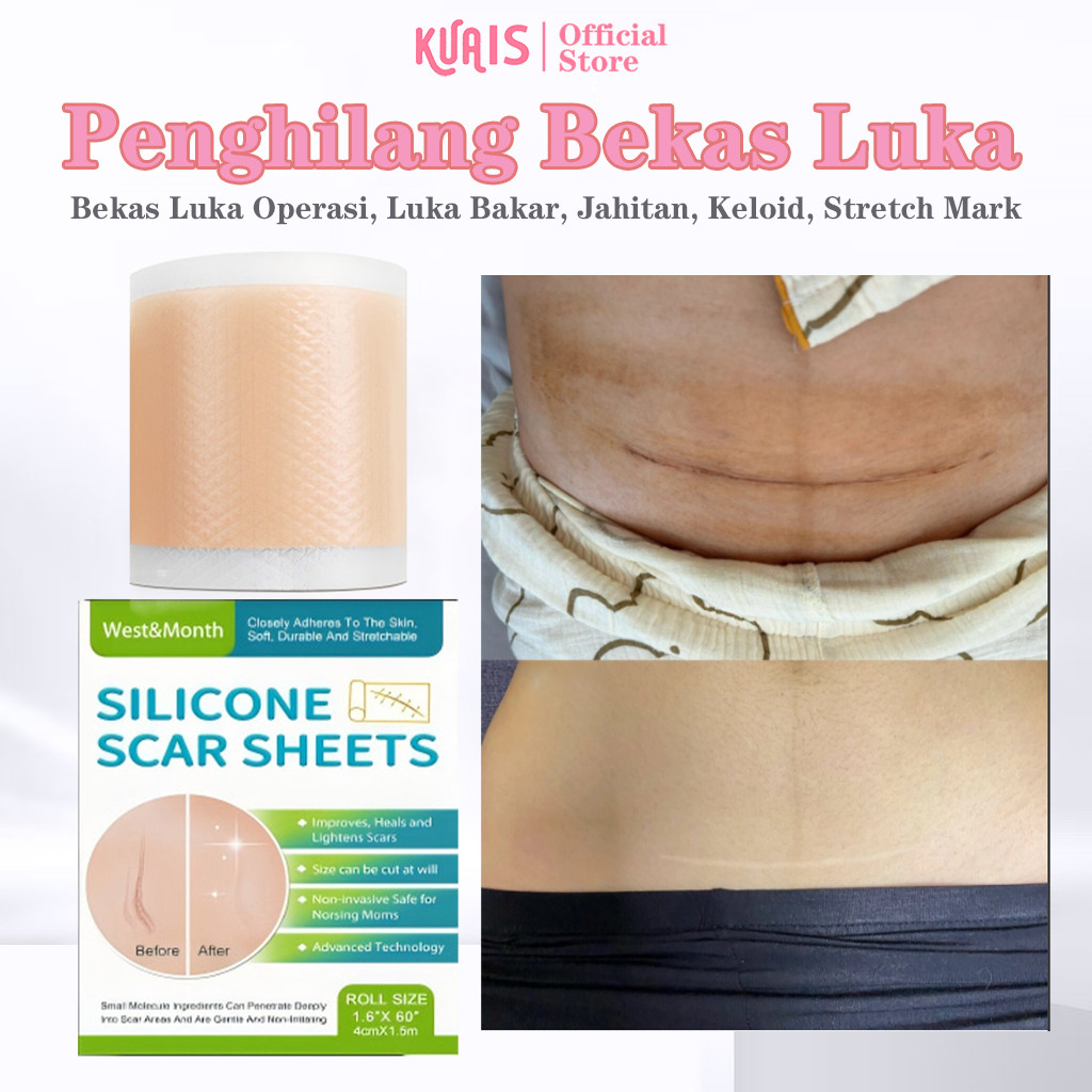 KUAIS Silicone Scar Sheet 4cm x 1.5m Penghilang Bekas Luka & Stretch Mark – Plester Keloid Medis Reu