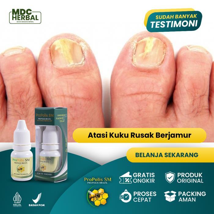 Kuku Rusak, Kuku Berjamur, Kuku Bau Busuk, Cantengan Jempol Kaki, Cantengan Tangan, Psoriasis Kuku, 